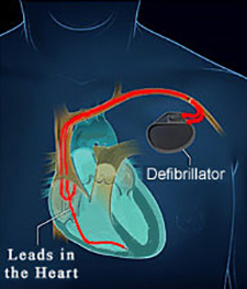 The Woodlands Texas Defibrillator (ICD) Placement